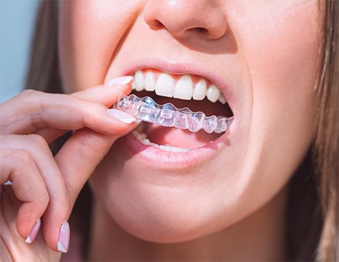 Woman putting clear aligners on upper teeth