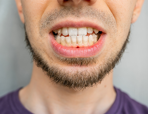 Bearded man with an underbite