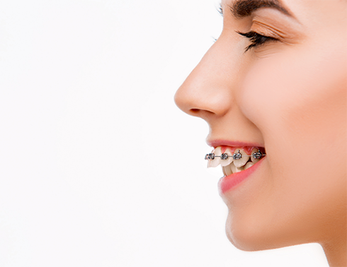 Person with braces and overbite