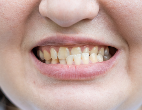 Close up of smile with crossbite