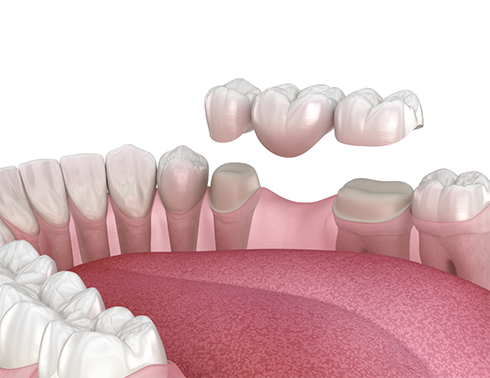 Illustration of dental bridge being placed on lower teeth