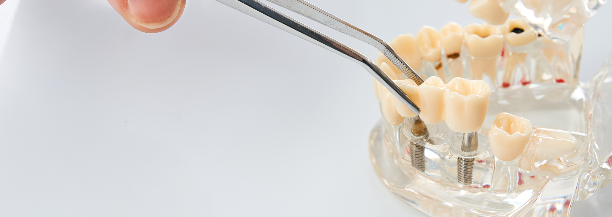 Attaching restoration to model of dental implant in Midland