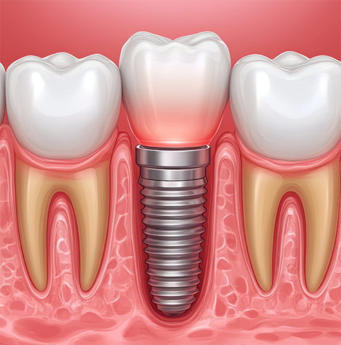 Illustration of a single dental implant