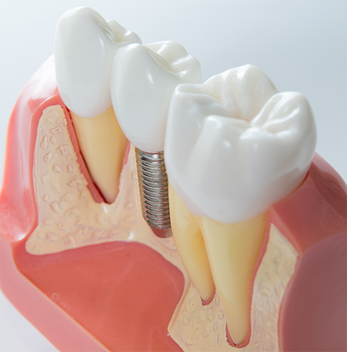 Close-up of model of dental implant