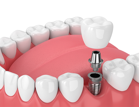 Illustration of dental crown and abutment being attached to dental implant