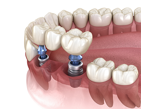 Illustration of dental bridge being attached to dental implants