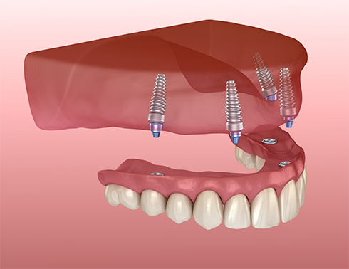 Illustration of denture being attached to upper dental implants