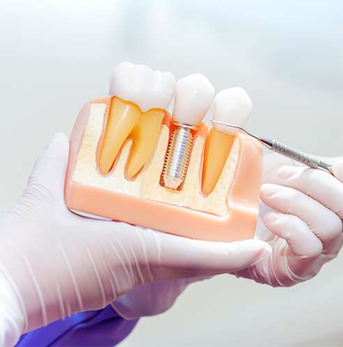 Holding model of a dental implant