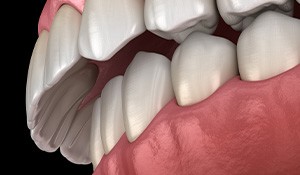 diagram of an overbite 