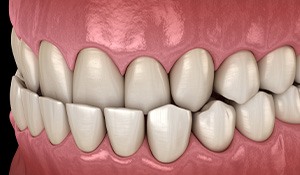 diagram of an underbite 