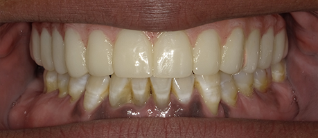 Smile after teeth have been replaced