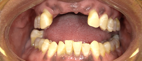 Smile with multiple teeth missing in upper arch