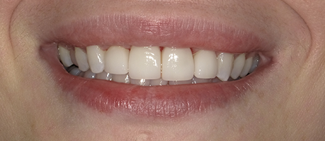 Melinda's teeth after treatment