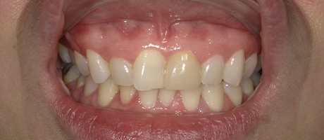 Melinda's teeth before treatment