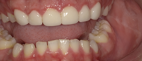 Smile after teeth have been rebuilt