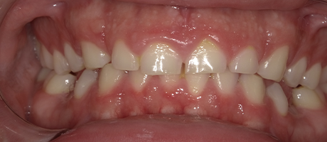 smile with significantly worn down teeth