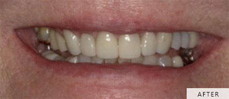 Frances's smile after full-mouth rehabilitation