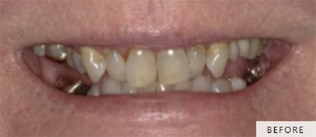 Frances's smile before full mouth rehabilitation