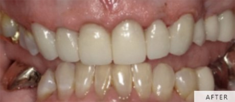 Close-up of Frances's smile after treatment