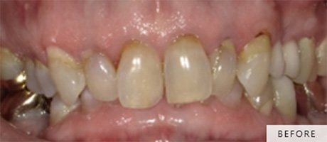 Close-up of Frances's smile before treatment