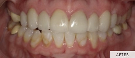 Smile after gap has been closed with veneers