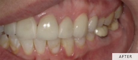 Close up of teeth that match each other more closely