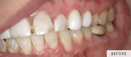 Close up of teeth that are differently shaded