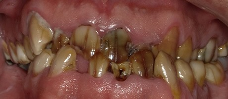 Mouth full of badly discolored teeth