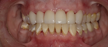 Anna's smile with restored teeth