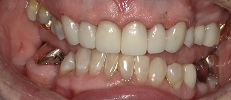 Smile with lighter looking teeth