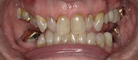 Smile with noticeably darkened teeth