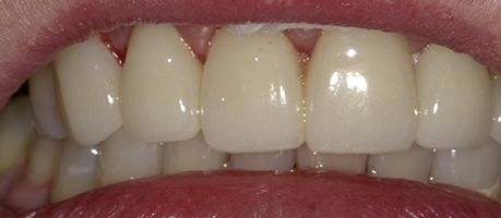 Whiter smile with repaired tooth