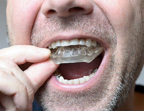 Older man putting occlusal splint on upper teeth